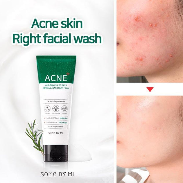 Foaming cleanser sales for acne