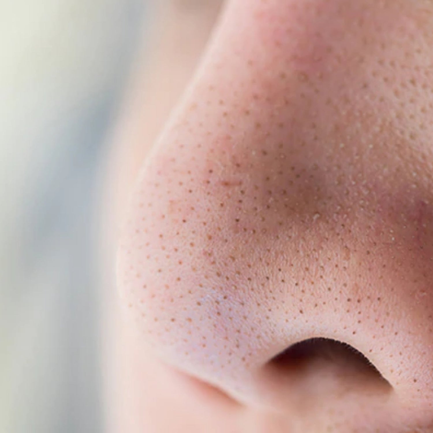 BLACKHEADS / WHITEHEADS