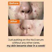 Blemish Care Routine Set