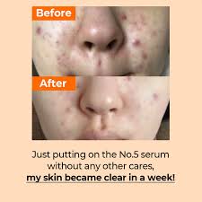 Blemish Care Routine Set