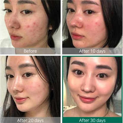 some by mi acne clear foam cleanser aha bha pha miracle toner serum cream set before and after results