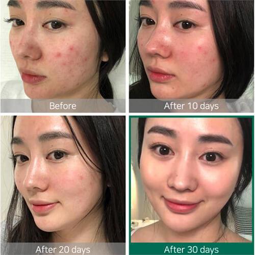 some by mi acne clear foam cleanser aha bha pha miracle toner serum cream set before and after results