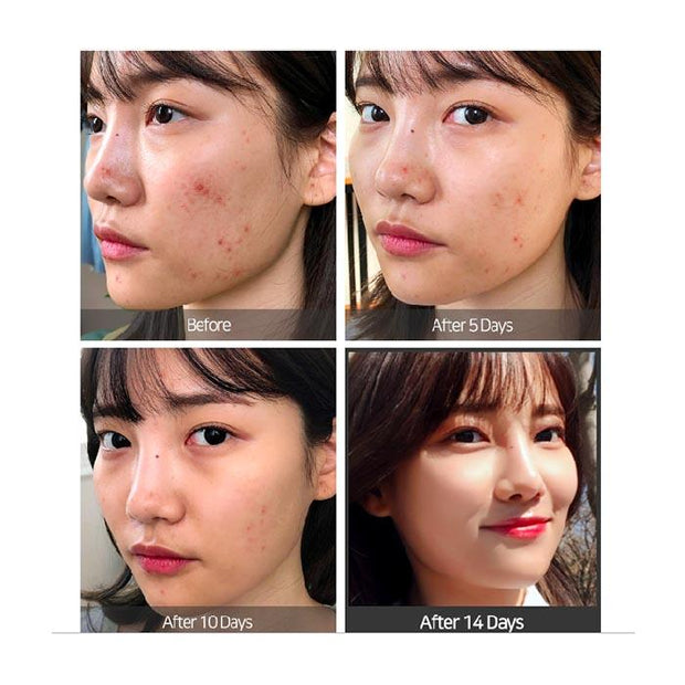 Somebymi Super Miracle Spot All Kill Cream (acne spot care),30ml